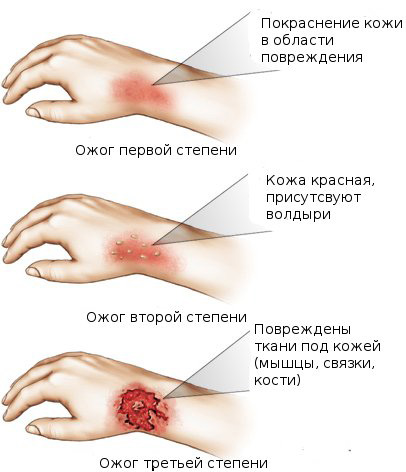 Виды, степени и лечение ожогов