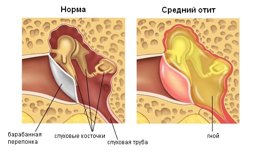 Левосторонний острый экссудативный средний отит