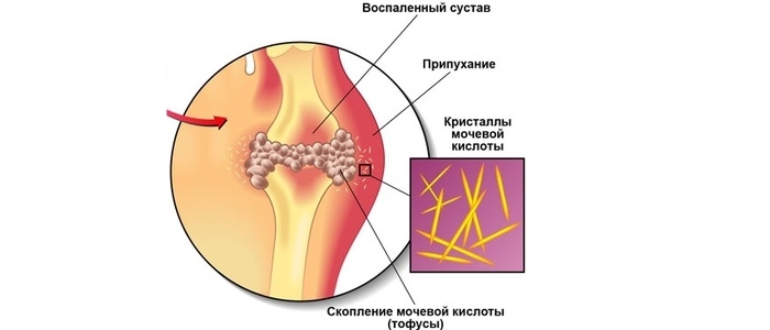Схема подагры