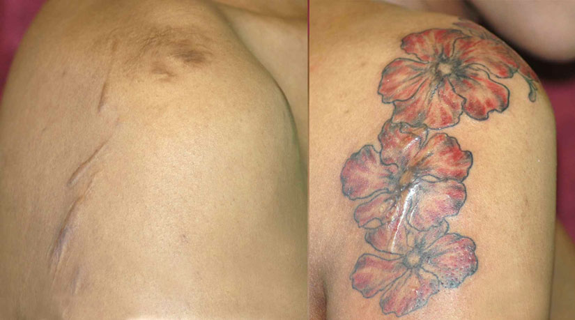 Тату поверх шрама на плече Тату поверх шрама на плече