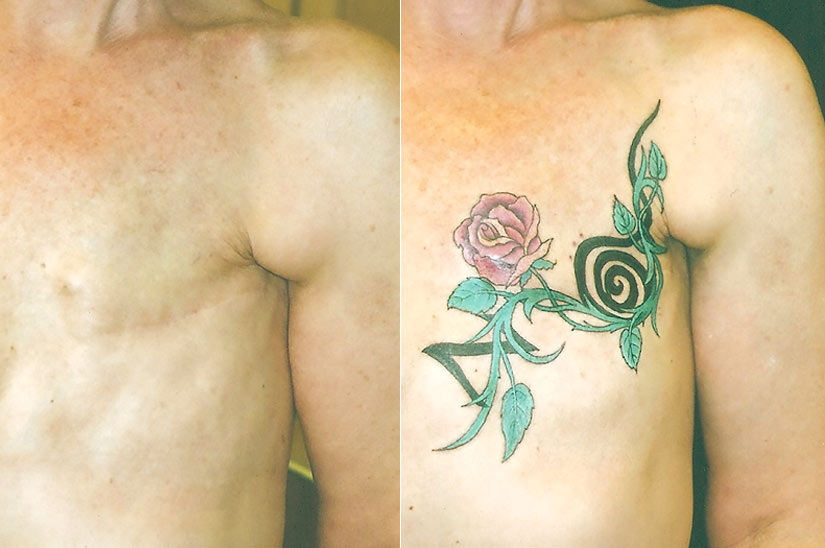 Тату, чтобы скрыть шрам после операции Тату, чтобы скрыть шрам после операции