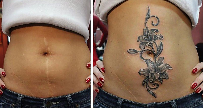 Тату на шрамах Тату на шрамах