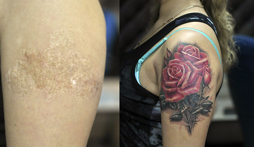 Забить шрам тату поверх ожогов Забить шрам тату поверх ожогов